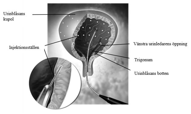 Urinblåsan som visar injektionsställen utspridda över detrusormuskeln