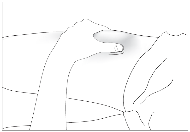 Bild 7. Desinficera injektionsstället på huden med en spritsudd och nyp ihop huden mellan tummen och pekfingret utan att klämma.