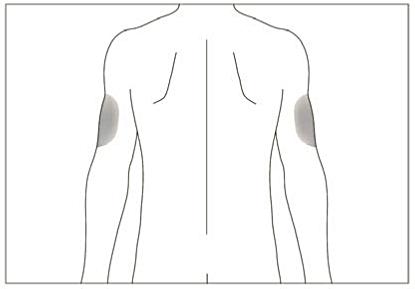 Bild beskriver hur injektion med hjälp kan ges på armens baksida.