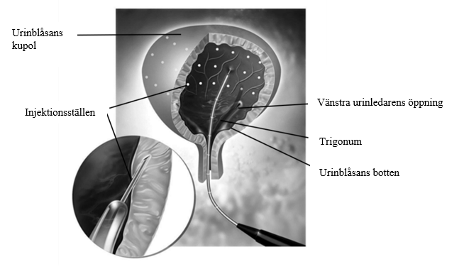 Urinblåsan som visar injektionsställen utspridda över detrusormuskeln