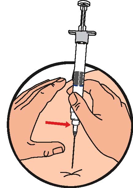 Rengör injektionsstället och injicera all vätska subkutant 