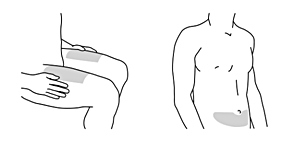 Figur 2 visar val av injektionsställe (framsidan av låren)
